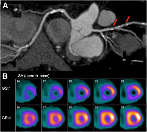 lv gated images|Transient ischemic dilation: An old but not obsolete marker of .